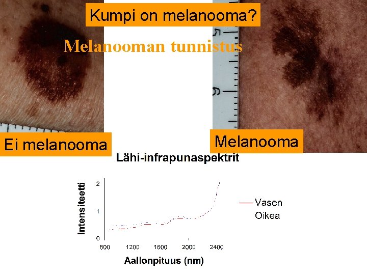 Kumpi on melanooma? Melanooman tunnistus Ei melanooma Melanooma 