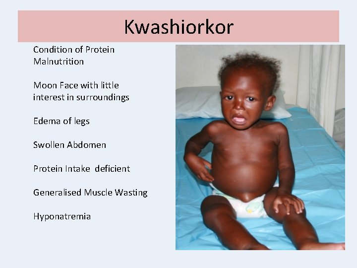 Kwashiorkor Condition of Protein Malnutrition Moon Face with little interest in surroundings Edema of