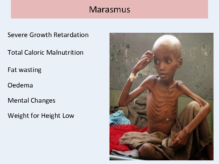 Marasmus Severe Growth Retardation Total Caloric Malnutrition Fat wasting Oedema Mental Changes Weight for