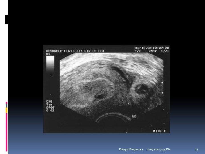 Ectopic Pregnancy 11/1/2020 7: 45 PM 13 