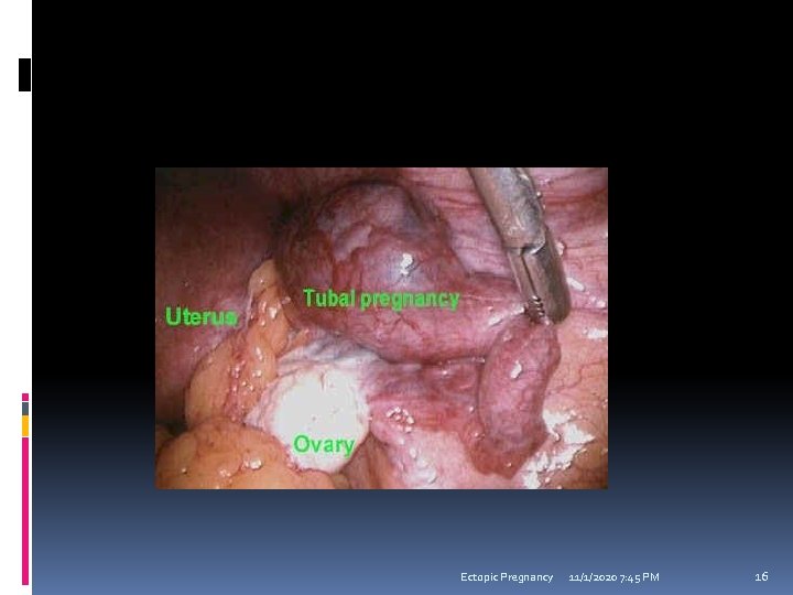 Ectopic Pregnancy 11/1/2020 7: 45 PM 16 