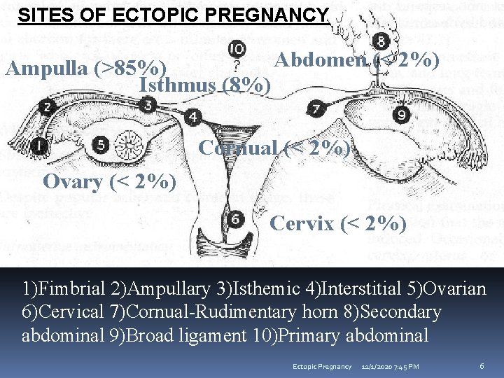 SITES OF ECTOPIC PREGNANCY Abdomen (< 2%) Ampulla (>85%) Isthmus (8%) Cornual (< 2%)