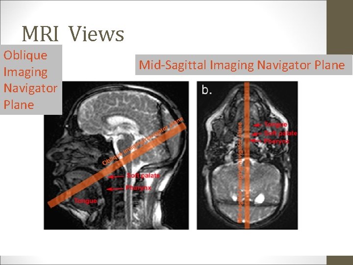 MRI Views Oblique Imaging Navigator Plane Mid-Sagittal Imaging Navigator Plane 