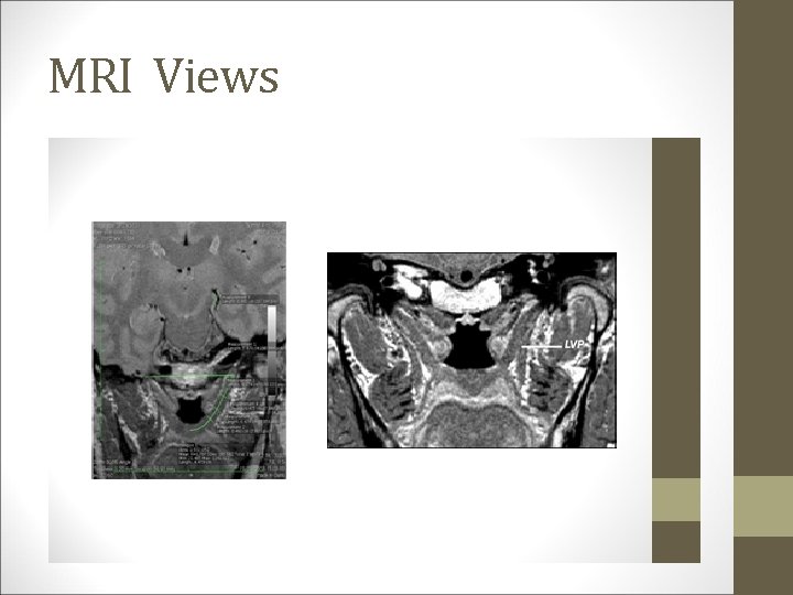 MRI Views 