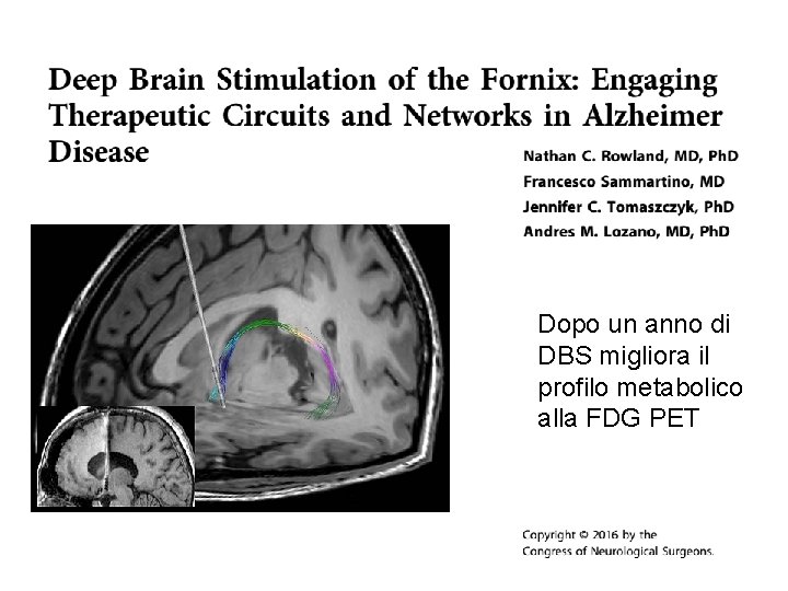 Dopo un anno di DBS migliora il profilo metabolico alla FDG PET 