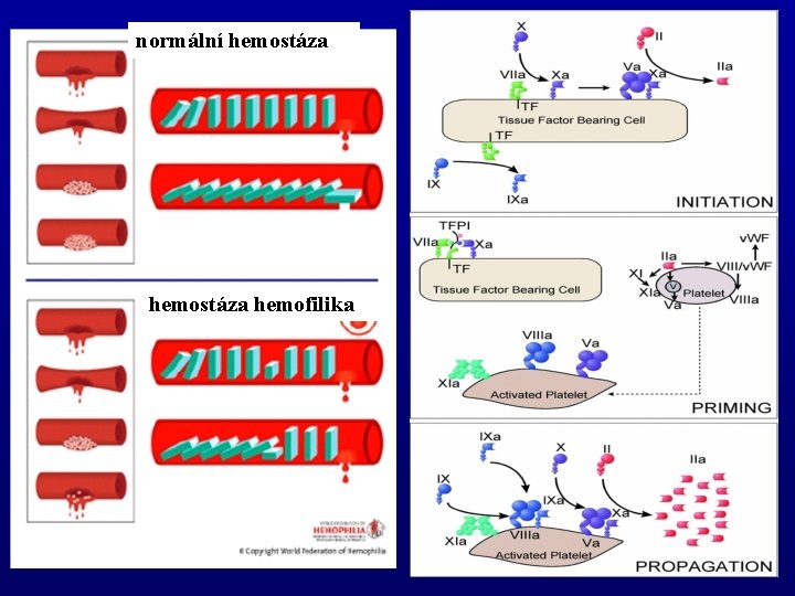 normální hemostáza hemofilika 