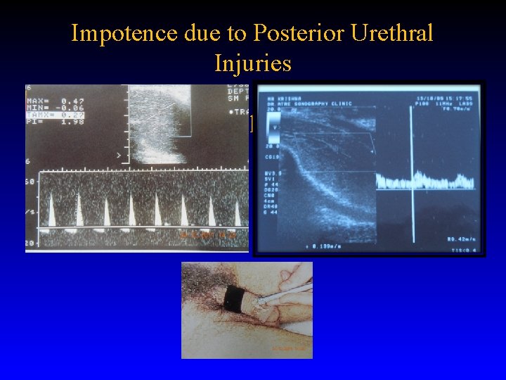 Impotence due to Posterior Urethral Injuries Duplex Color Doppler 