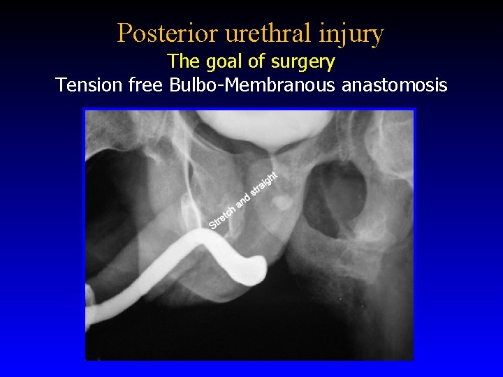 Posterior urethral injury The goal of surgery Tension free Bulbo-Membranous anastomosis 