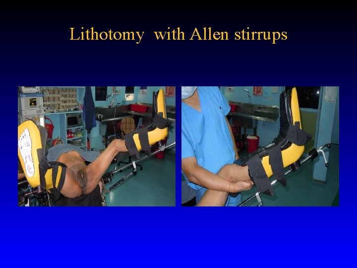 Lithotomy with Allen stirrups 