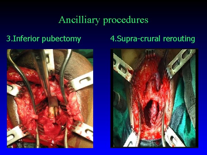 Ancilliary procedures 3. Inferior pubectomy 4. Supra-crural rerouting 