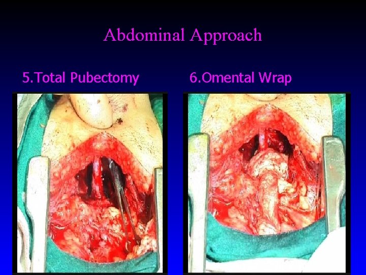 Abdominal Approach 5. Total Pubectomy 6. Omental Wrap Abdominal Approach 5. Total Pubectomy 6. Omental Wrap