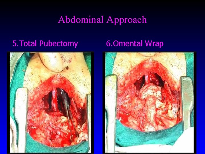 Abdominal Approach 5. Total Pubectomy 6. Omental Wrap 