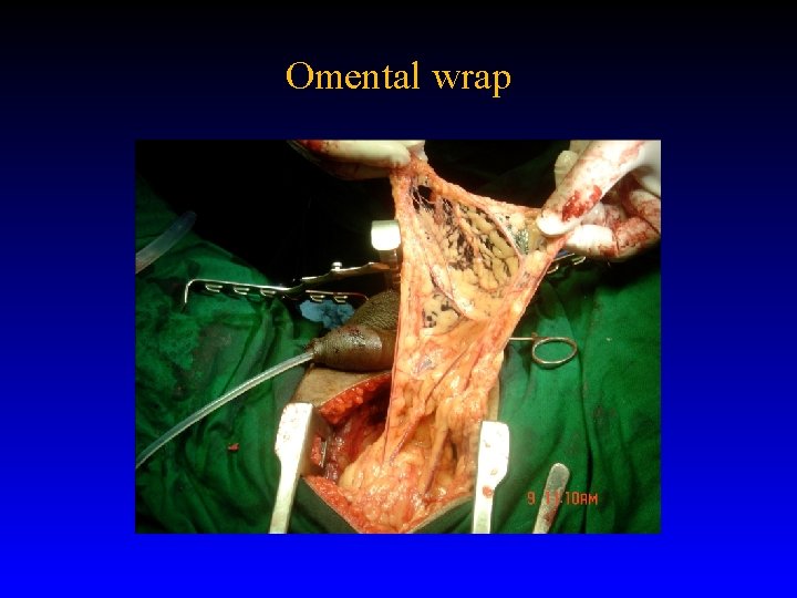 Omental wrap 