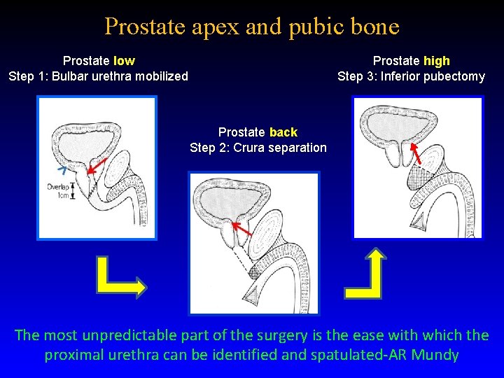 Prostate apex and pubic bone Prostate low Step 1: Bulbar urethra mobilized Prostate high Prostate apex and pubic bone Prostate low Step 1: Bulbar urethra mobilized Prostate high
