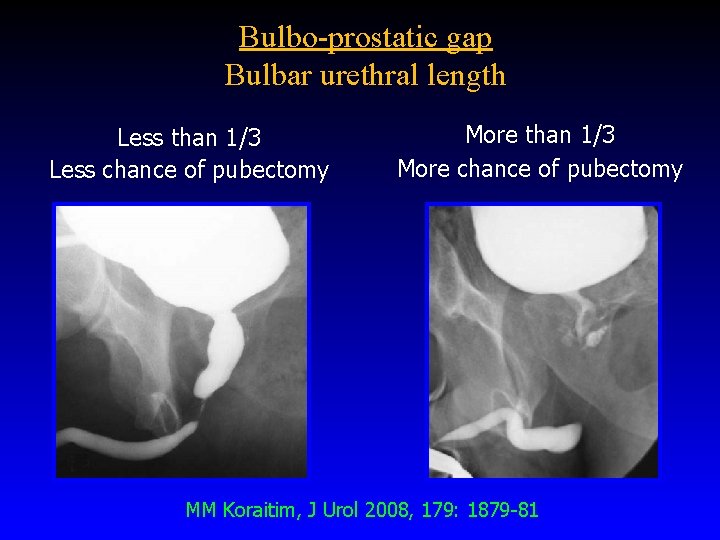 Bulbo-prostatic gap Bulbar urethral length Less than 1/3 Less chance of pubectomy More than