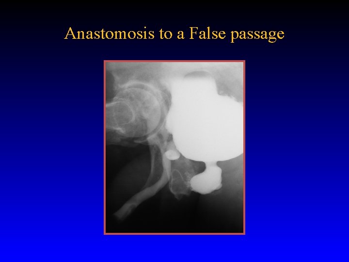 Anastomosis to a False passage 