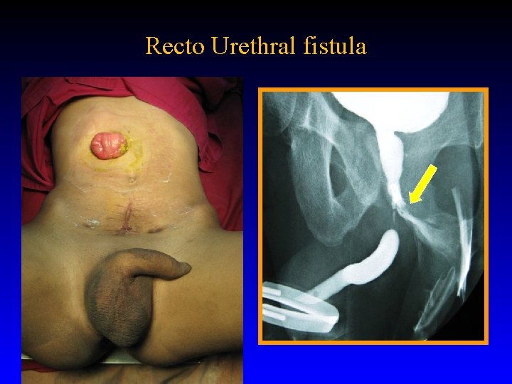 Recto Urethral fistula 