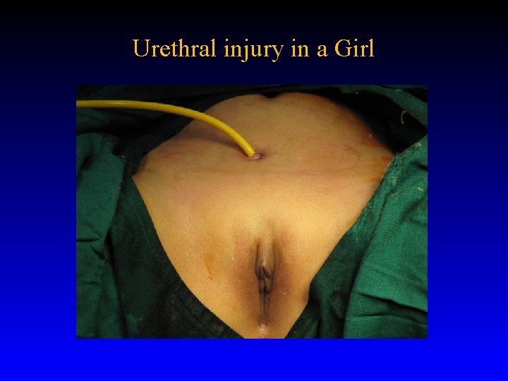 Urethral injury in a Girl Urethral injury in a Girl