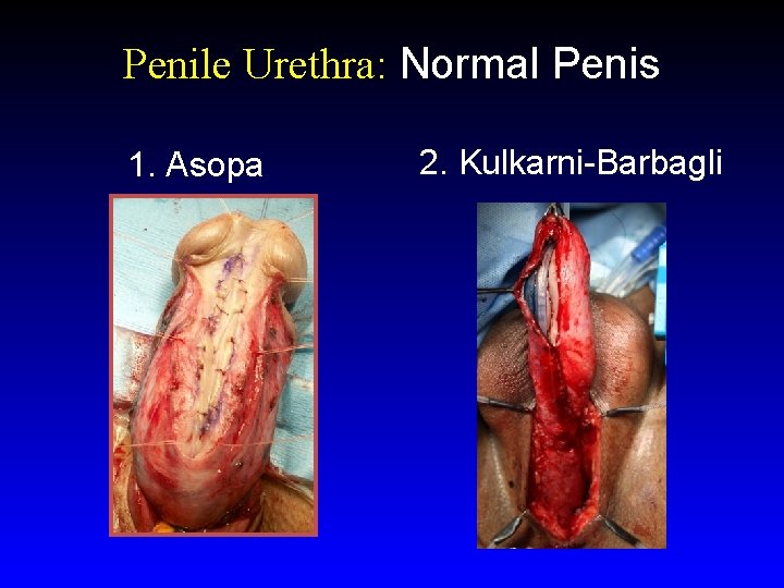 Penile Urethra: Normal Penis 1. Asopa 2. Kulkarni-Barbagli 