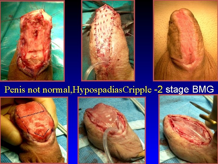 Penis not normal, Hypospadias. Cripple -2 stage BMG 