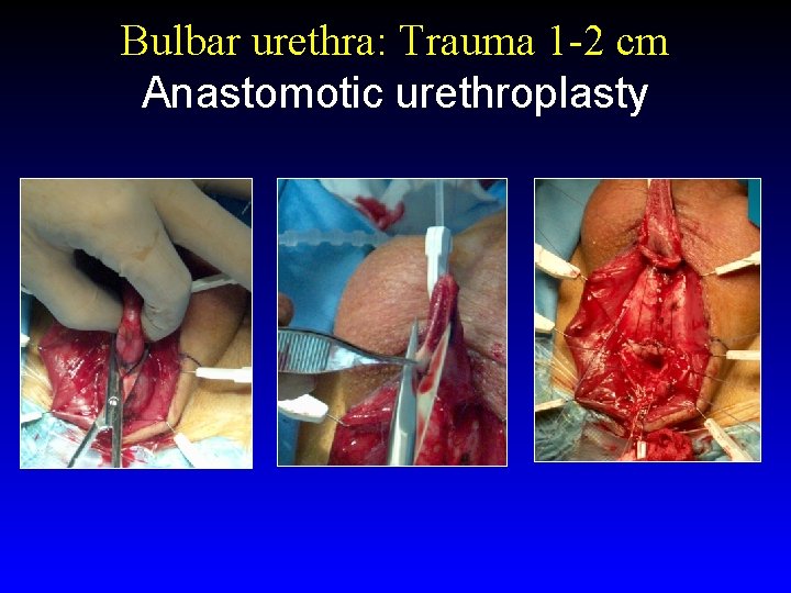 Bulbar urethra: Trauma 1 -2 cm Anastomotic urethroplasty 