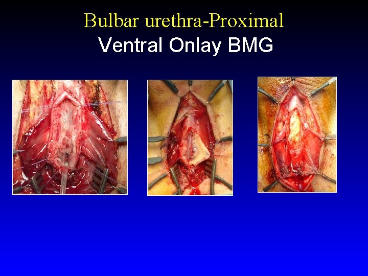 Bulbar urethra-Proximal Ventral Onlay BMG 