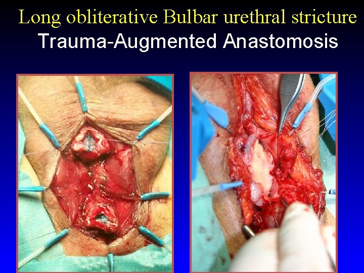 Long obliterative Bulbar urethral stricture Trauma-Augmented Anastomosis 