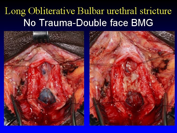 Long Obliterative Bulbar urethral stricture No Trauma-Double face BMG Long Obliterative Bulbar urethral stricture No Trauma-Double face BMG