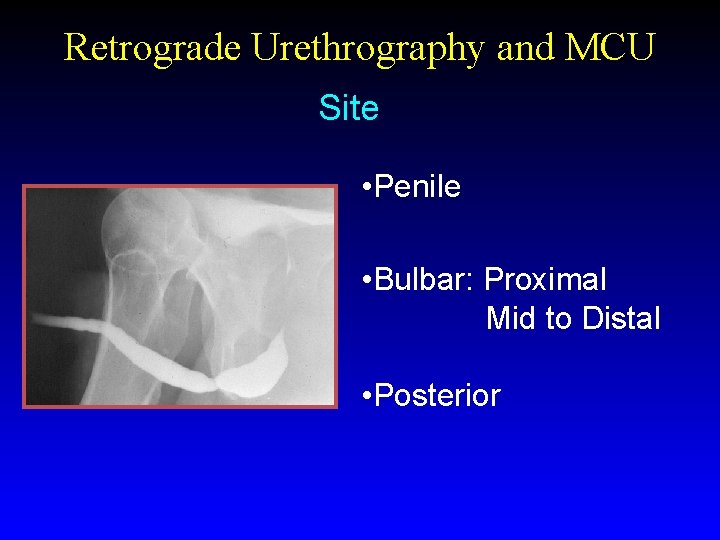 Retrograde Urethrography and MCU Site • Penile • Bulbar: Proximal Mid to Distal •