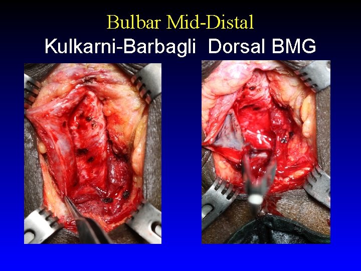 Bulbar Mid-Distal Kulkarni-Barbagli Dorsal BMG 