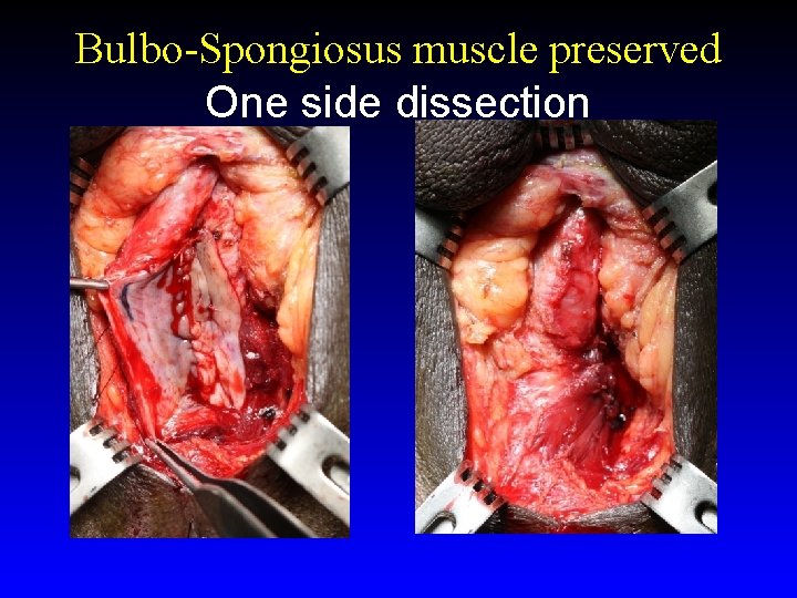 Bulbo-Spongiosus muscle preserved One side dissection 