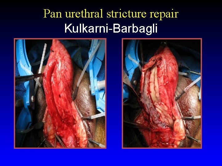 Pan urethral stricture repair Kulkarni-Barbagli 