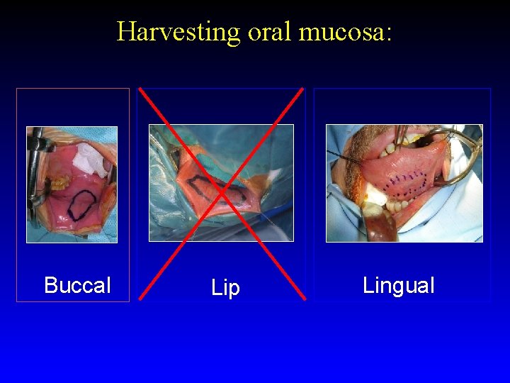 Harvesting oral mucosa: Buccal Lip Lingual 