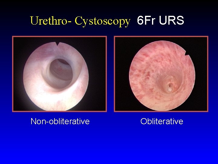 Urethro- Cystoscopy 6 Fr URS Non-obliterative Obliterative 