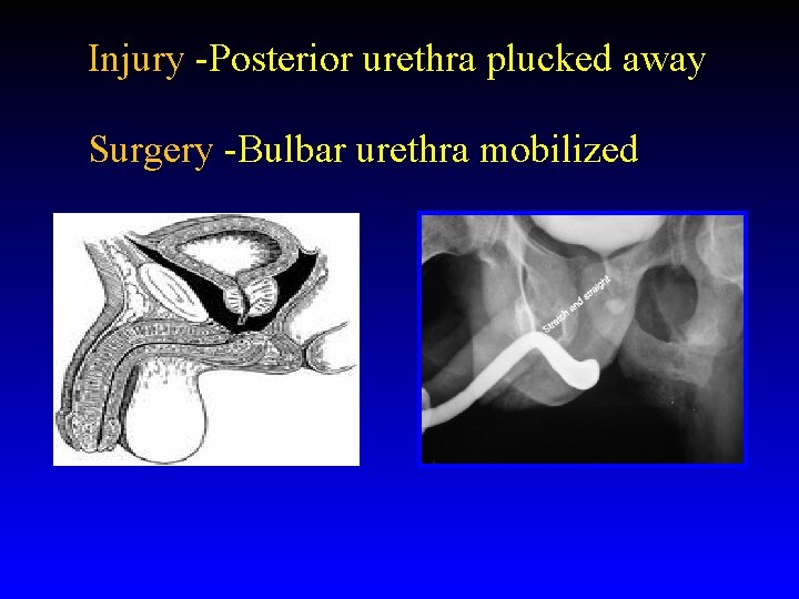 Injury -Posterior urethra plucked away Surgery -Bulbar urethra mobilized Injury -Posterior urethra plucked away Surgery -Bulbar urethra mobilized