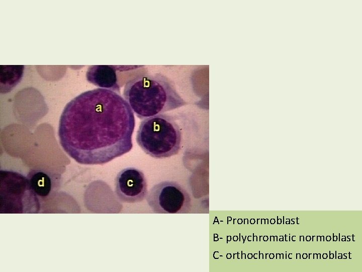A- Pronormoblast B- polychromatic normoblast C- orthochromic normoblast 