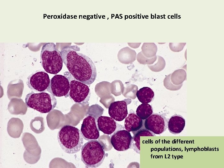 Peroxidase negative , PAS positive blast cells of the different populations, lymphoblasts from L