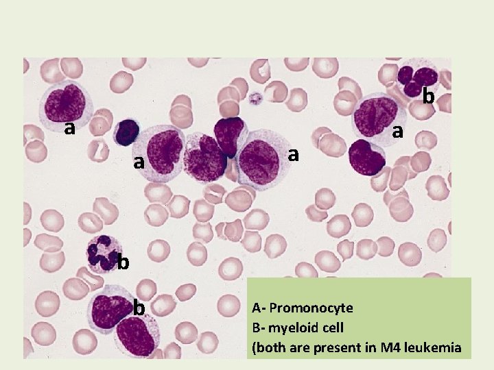 b a a b b A- Promonocyte B- myeloid cell (both are present in
