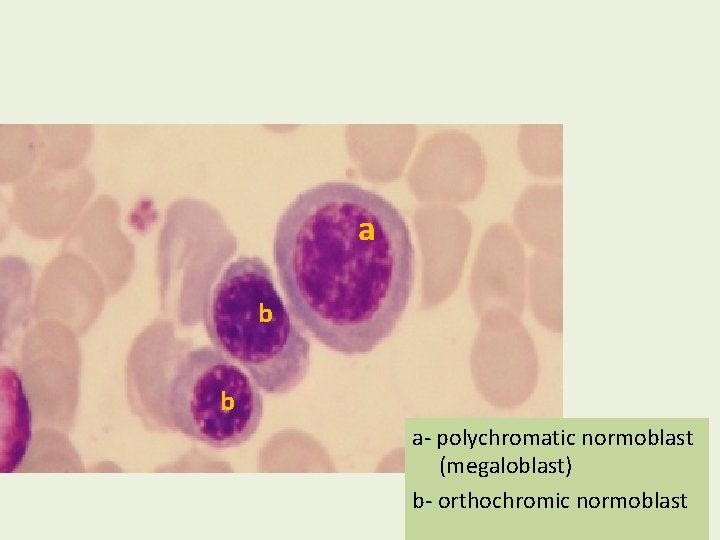 a b b a- polychromatic normoblast (megaloblast) b- orthochromic normoblast 