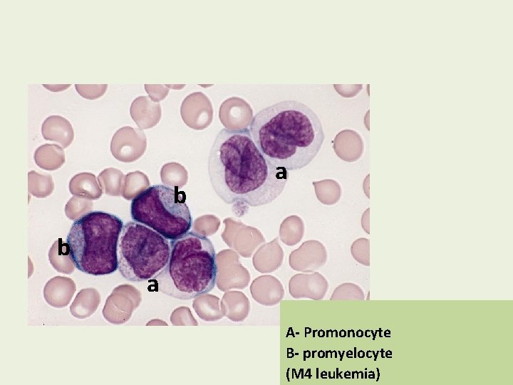 b a A- Promonocyte B- promyelocyte (M 4 leukemia) 