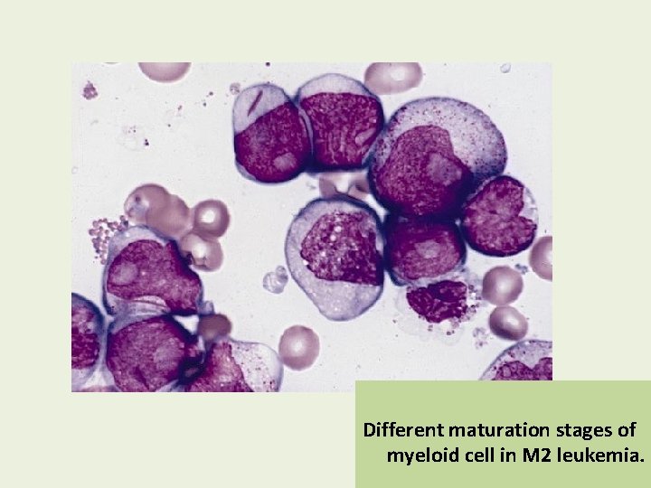 Different maturation stages of myeloid cell in M 2 leukemia. 