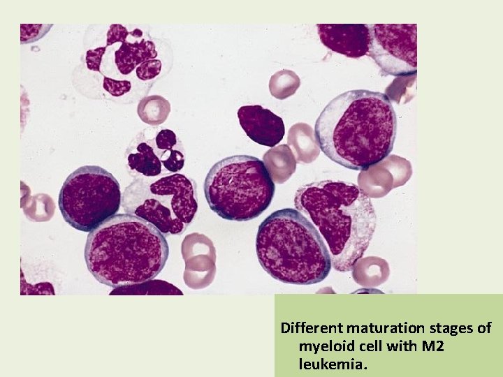 Different maturation stages of myeloid cell with M 2 leukemia. 