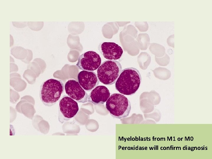 Myeloblasts from M 1 or M 0 Peroxidase will confirm diagnosis 