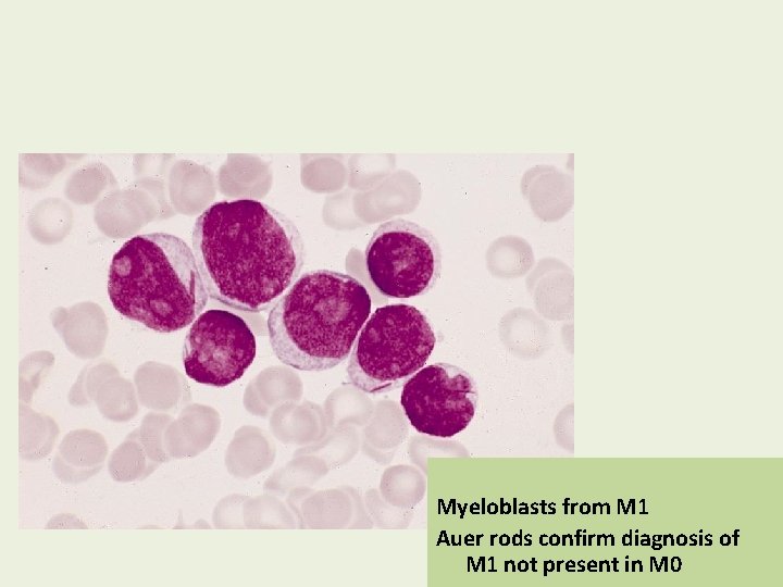 Myeloblasts from M 1 Auer rods confirm diagnosis of M 1 not present in