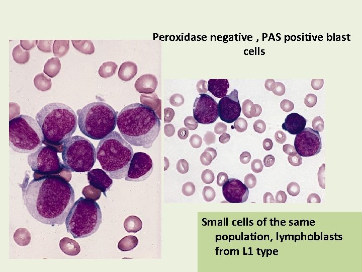 Peroxidase negative , PAS positive blast cells Small cells of the same population, lymphoblasts