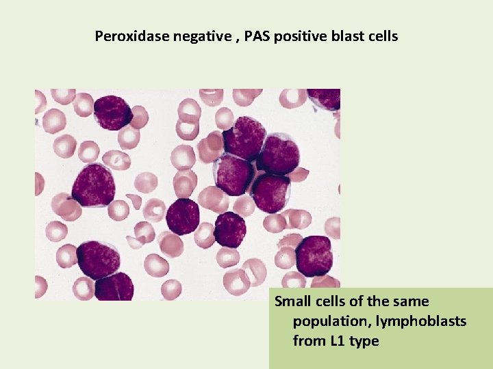 Peroxidase negative , PAS positive blast cells Small cells of the same population, lymphoblasts