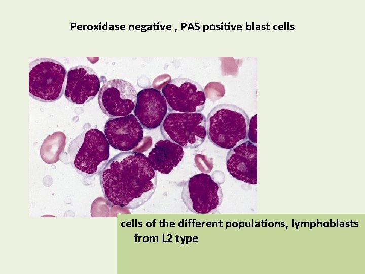 Peroxidase negative , PAS positive blast cells of the different populations, lymphoblasts from L