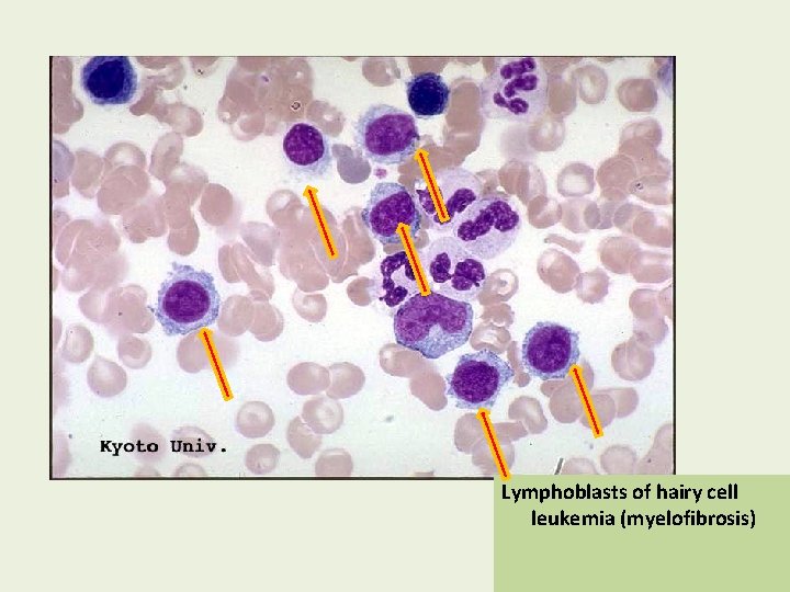 Lymphoblasts of hairy cell leukemia (myelofibrosis) 