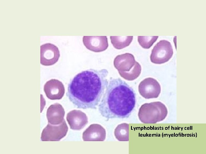 Lymphoblasts of hairy cell leukemia (myelofibrosis) 