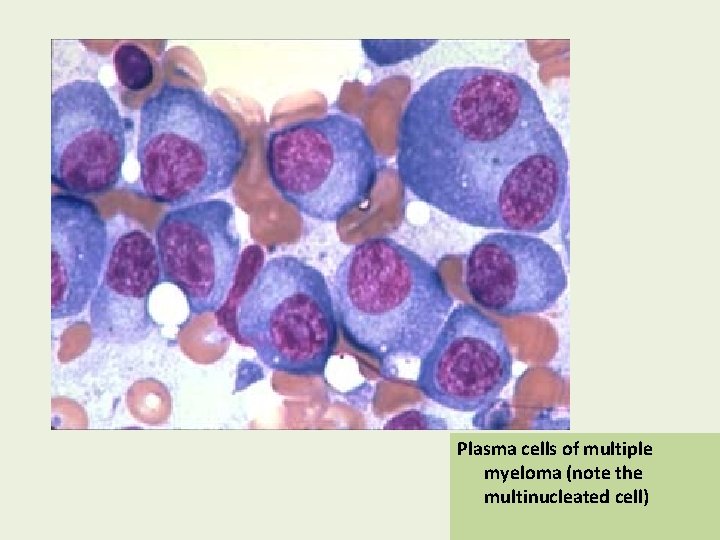 Plasma cells of multiple myeloma (note the multinucleated cell) 